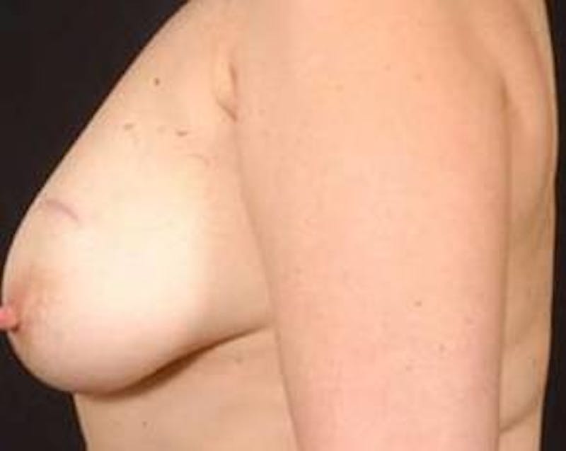 Prophylactic Mastectomy Before & After Gallery - Patient 412231 - Image 3