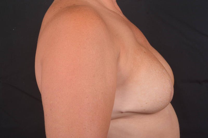 Immediate Breast Reconstruction – Skin Sparing Before & After Gallery - Patient 364612 - Image 6
