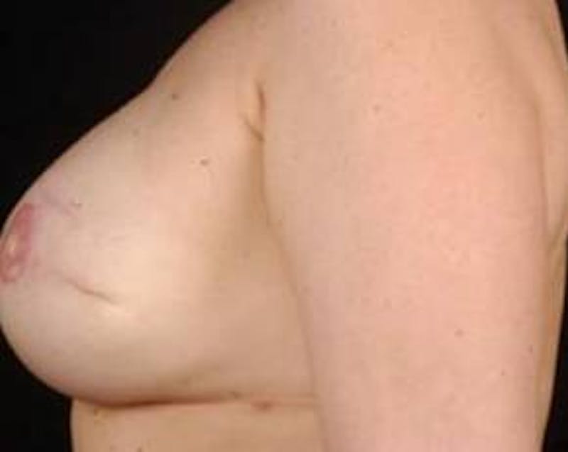 Prophylactic Mastectomy Before & After Gallery - Patient 412231 - Image 4