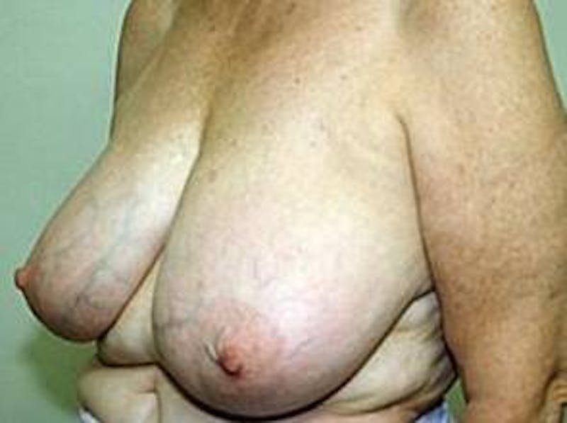 Breast Reduction Before & After Gallery - Patient 404027 - Image 3