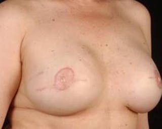 Prophylactic Mastectomy Before & After Gallery - Patient 412231 - Image 6