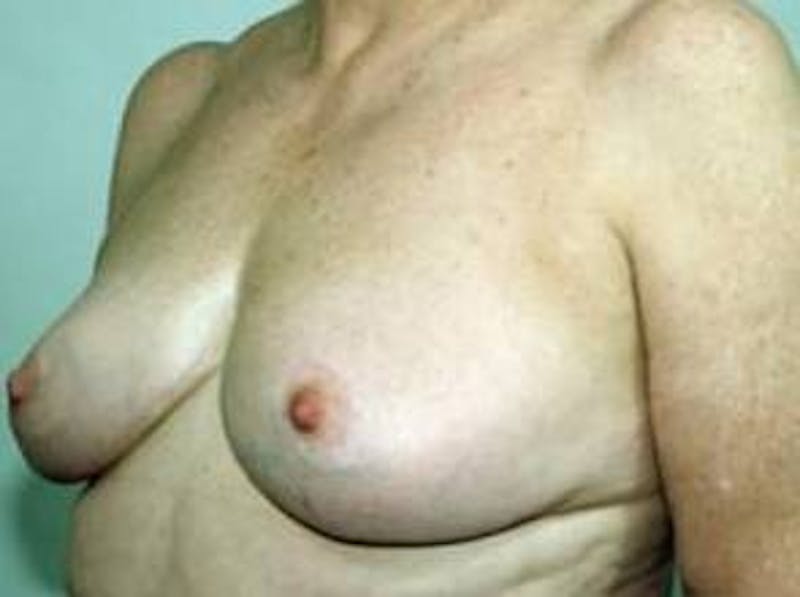 Breast Reduction Before & After Gallery - Patient 404027 - Image 4