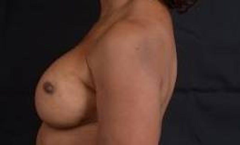 Reconstructive Breast Revision Before & After Gallery - Patient 407119 - Image 3