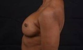 Reconstructive Breast Revision Before & After Gallery - Patient 407119 - Image 4