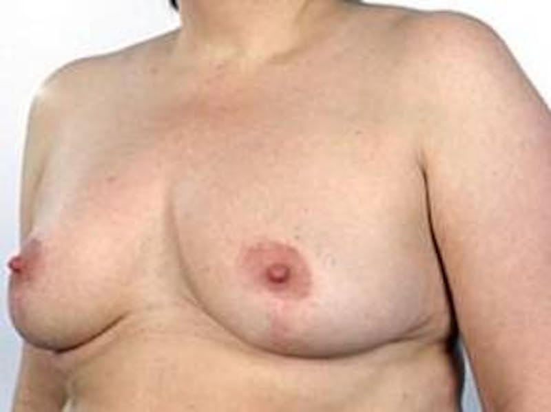 Breast Reduction Before & After Gallery - Patient 301172 - Image 4