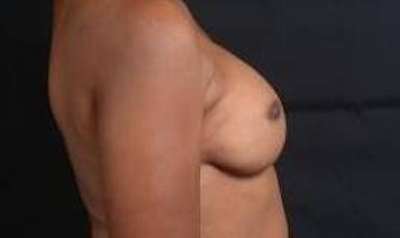 Reconstructive Breast Revision Before & After Gallery - Patient 407119 - Image 5