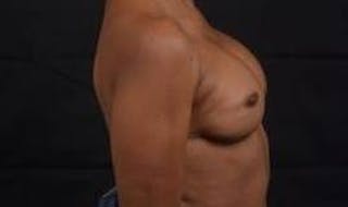 Reconstructive Breast Revision Before & After Gallery - Patient 407119 - Image 6