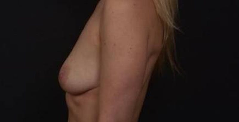 Breast Augmentation Mastopexy Before & After Gallery - Patient 300515 - Image 9