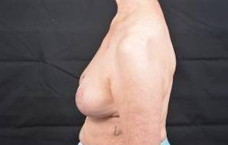 Oncoplastic Reconstruction Before & After Gallery - Patient 248604 - Image 3