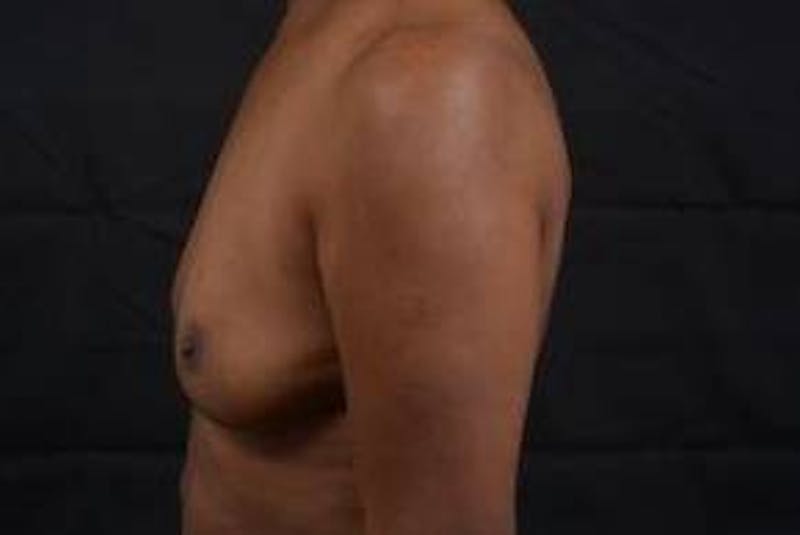 Immediate Breast Reconstruction – Skin Sparing Before & After Gallery - Patient 184310 - Image 3