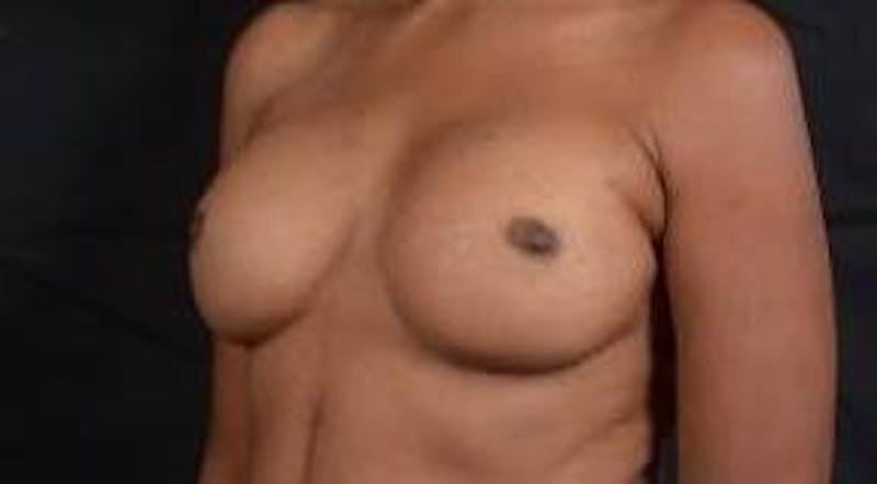 Reconstructive Breast Revision Before & After Gallery - Patient 407119 - Image 7