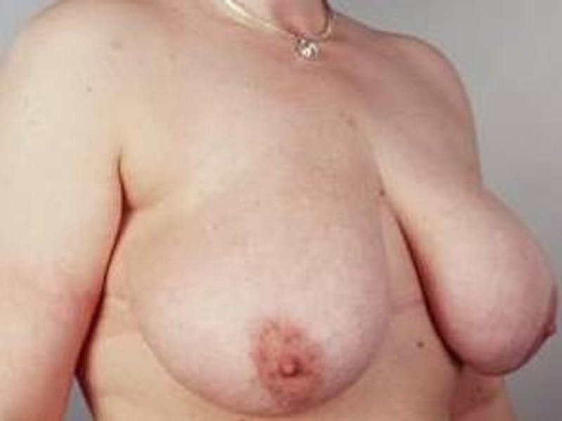 Breast Reduction Before & After Gallery - Patient 792622 - Image 3
