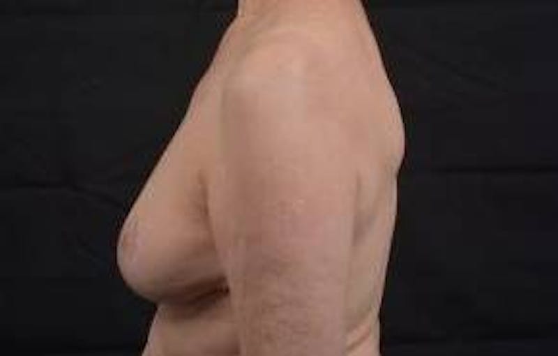 Oncoplastic Reconstruction Before & After Gallery - Patient 248604 - Image 4