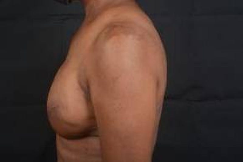 Immediate Breast Reconstruction – Skin Sparing Before & After Gallery - Patient 184310 - Image 4