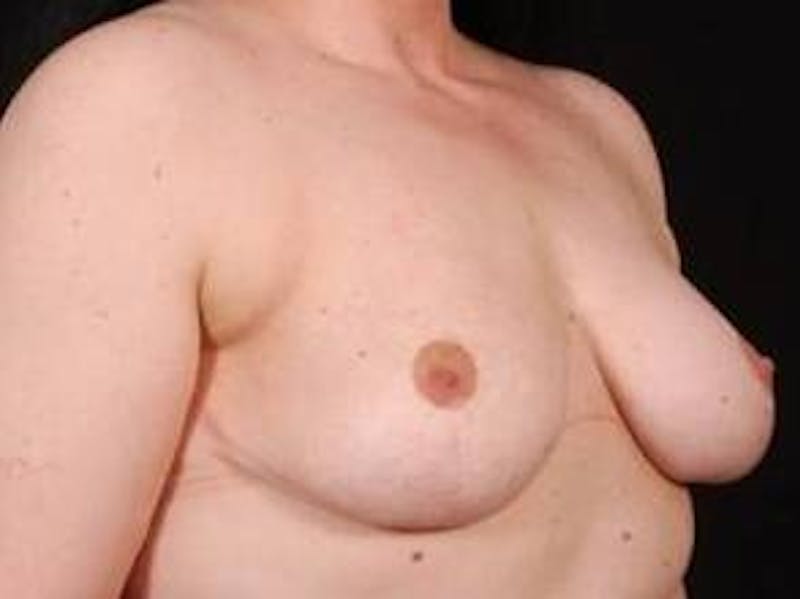 Breast Reduction Before & After Gallery - Patient 792622 - Image 4