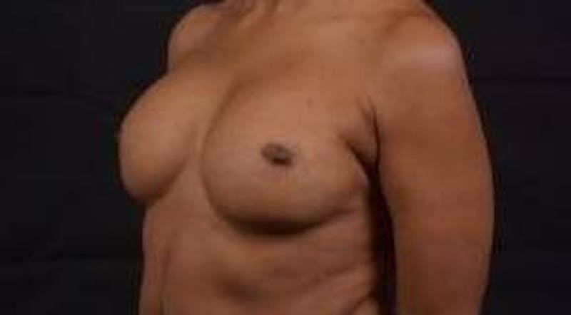 Reconstructive Breast Revision Before & After Gallery - Patient 407119 - Image 8