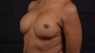 Reconstructive Breast Revision Before & After Gallery - Patient 407119 - Image 8