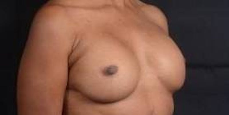 Reconstructive Breast Revision Before & After Gallery - Patient 407119 - Image 9