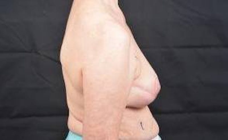 Oncoplastic Reconstruction Before & After Gallery - Patient 248604 - Image 5