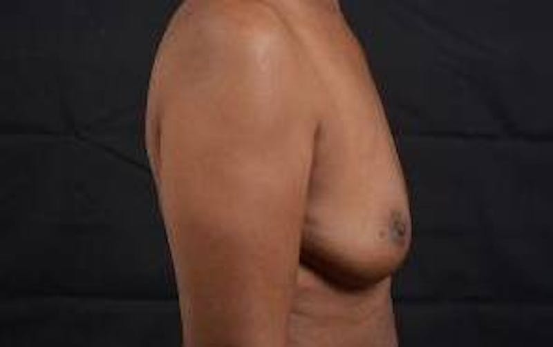 Immediate Breast Reconstruction – Skin Sparing Before & After Gallery - Patient 184310 - Image 5