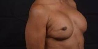 Reconstructive Breast Revision Before & After Gallery - Patient 407119 - Image 10