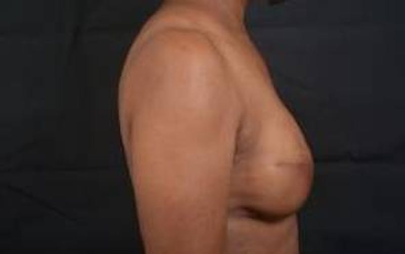 Immediate Breast Reconstruction – Skin Sparing Before & After Gallery - Patient 184310 - Image 6