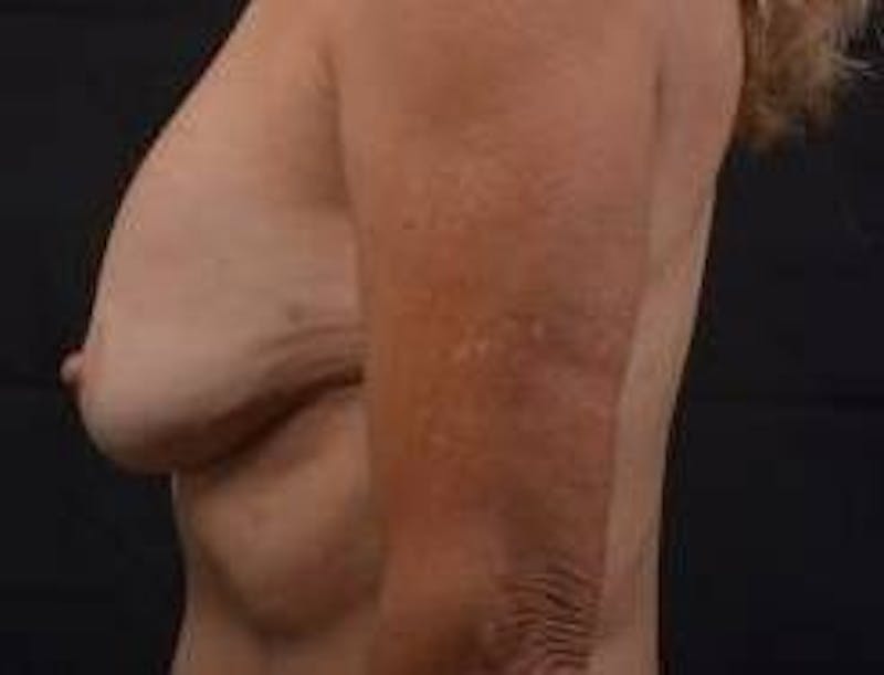 Aesthetic Breast Revision Before & After Gallery - Patient 103776 - Image 3