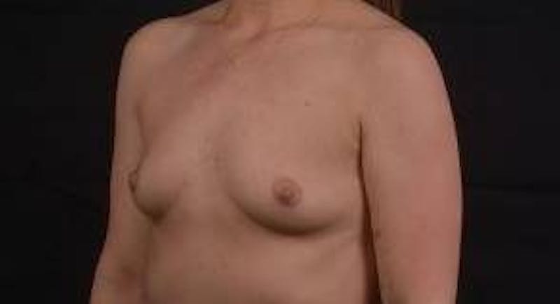 Immediate Breast Reconstruction – Nipple Sparing Before & After Gallery - Patient 418145 - Image 7