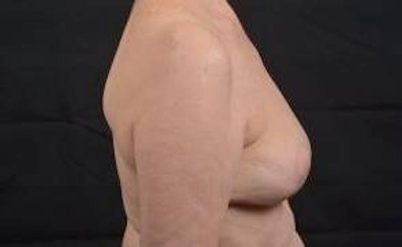 Oncoplastic Reconstruction Before & After Gallery - Patient 248604 - Image 6