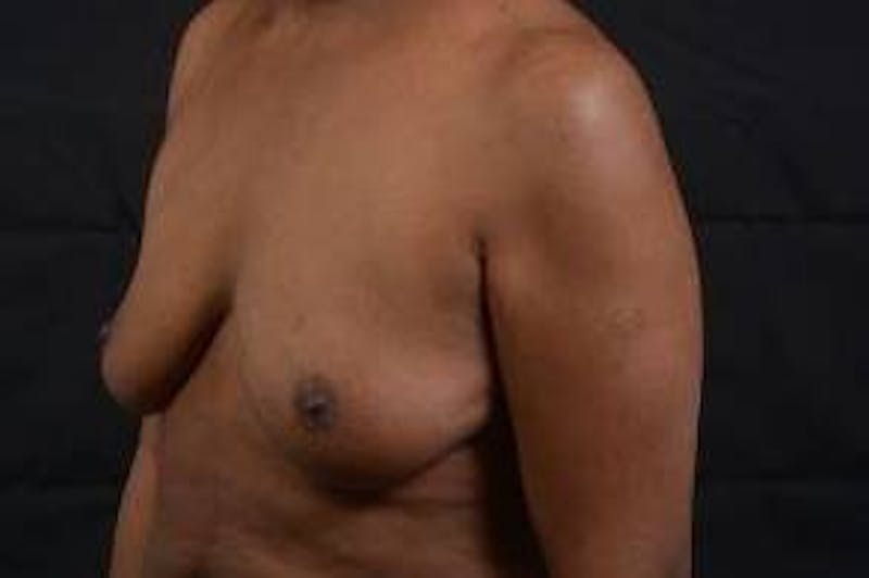 Immediate Breast Reconstruction – Skin Sparing Before & After Gallery - Patient 184310 - Image 7