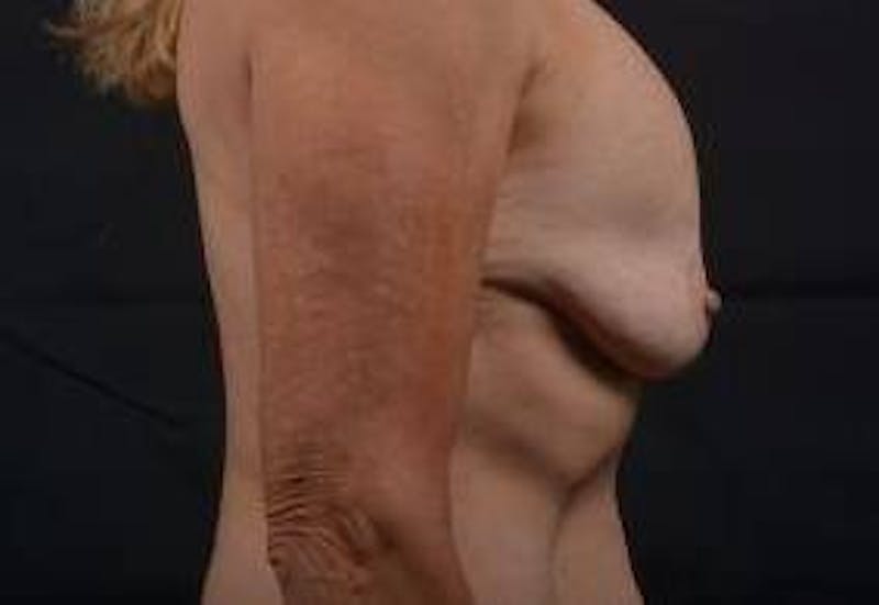 Aesthetic Breast Revision Before & After Gallery - Patient 103776 - Image 5