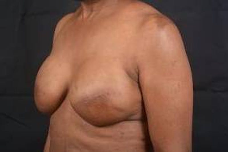Immediate Breast Reconstruction – Skin Sparing Before & After Gallery - Patient 184310 - Image 8