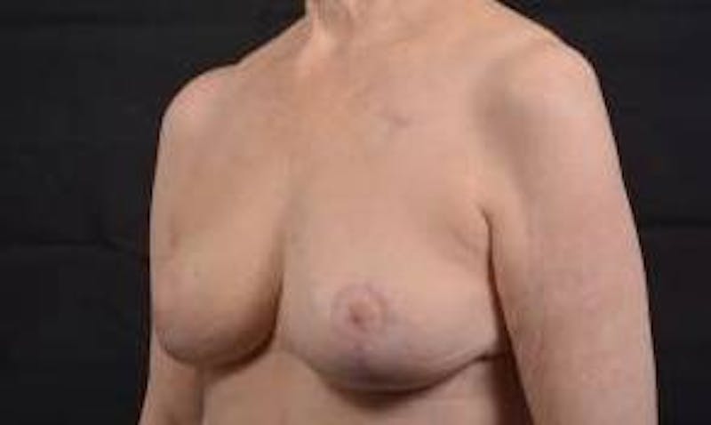 Oncoplastic Reconstruction Before & After Gallery - Patient 248604 - Image 8
