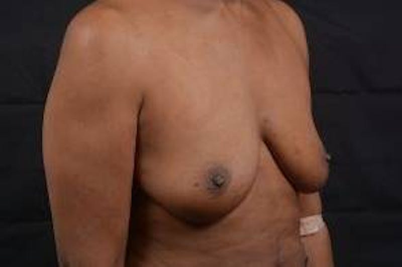 Immediate Breast Reconstruction – Skin Sparing Before & After Gallery - Patient 184310 - Image 9