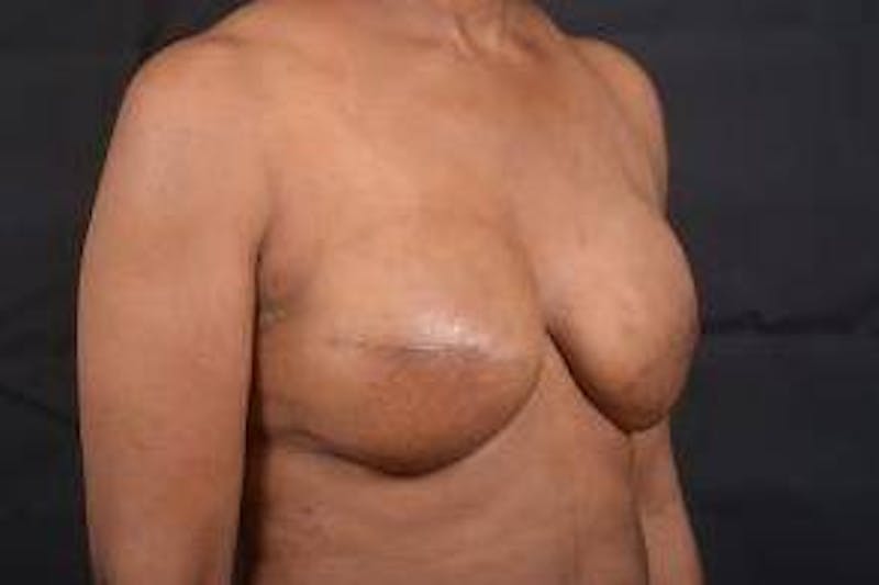 Immediate Breast Reconstruction – Skin Sparing Before & After Gallery - Patient 184310 - Image 10
