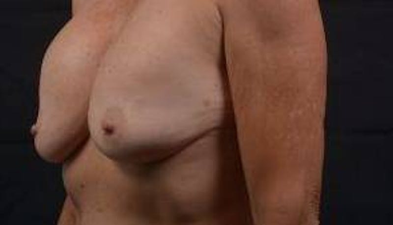Aesthetic Breast Revision Before & After Gallery - Patient 103776 - Image 7