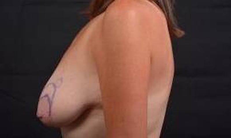 Immediate Breast Reconstruction – Skin Sparing Before & After Gallery - Patient 621368 - Image 3