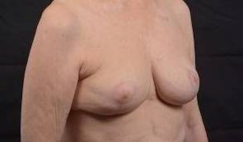 Oncoplastic Reconstruction Before & After Gallery - Patient 248604 - Image 10