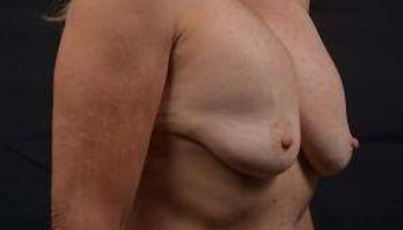 Aesthetic Breast Revision Before & After Gallery - Patient 103776 - Image 9
