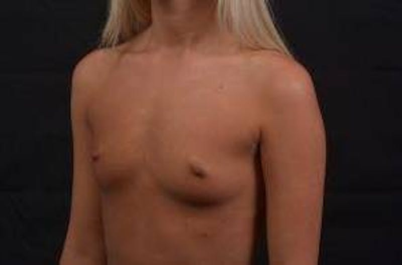 Breast Augmentation Silicone Gel Before & After Gallery - Patient 228658 - Image 7