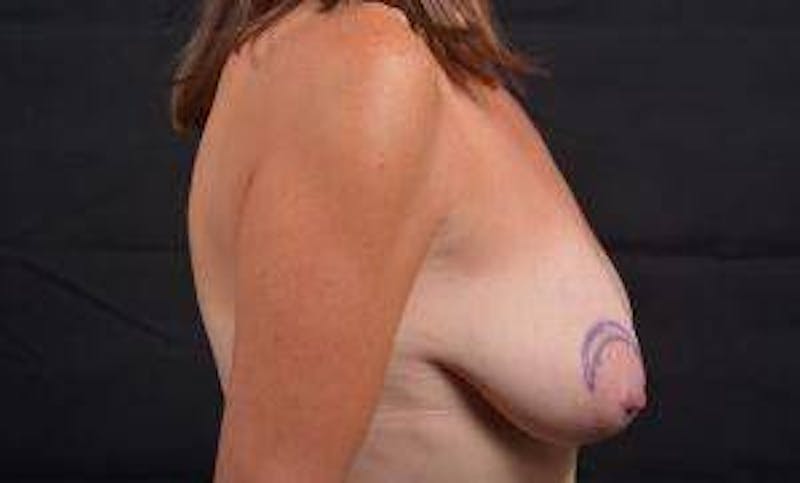 Immediate Breast Reconstruction – Skin Sparing Before & After Gallery - Patient 621368 - Image 5