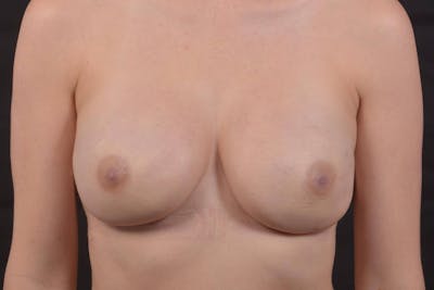 Immediate Breast Reconstruction – Nipple Sparing Before & After Gallery - Patient 647454 - Image 2