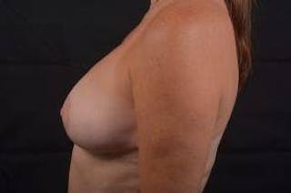 Oncoplastic Reconstruction Before & After Gallery - Patient 118368 - Image 4