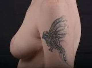 Mastopexy Before & After Gallery - Patient 656836 - Image 4