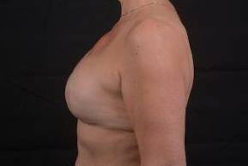 Reconstructive Breast Revision Before & After Gallery - Patient 348145 - Image 3