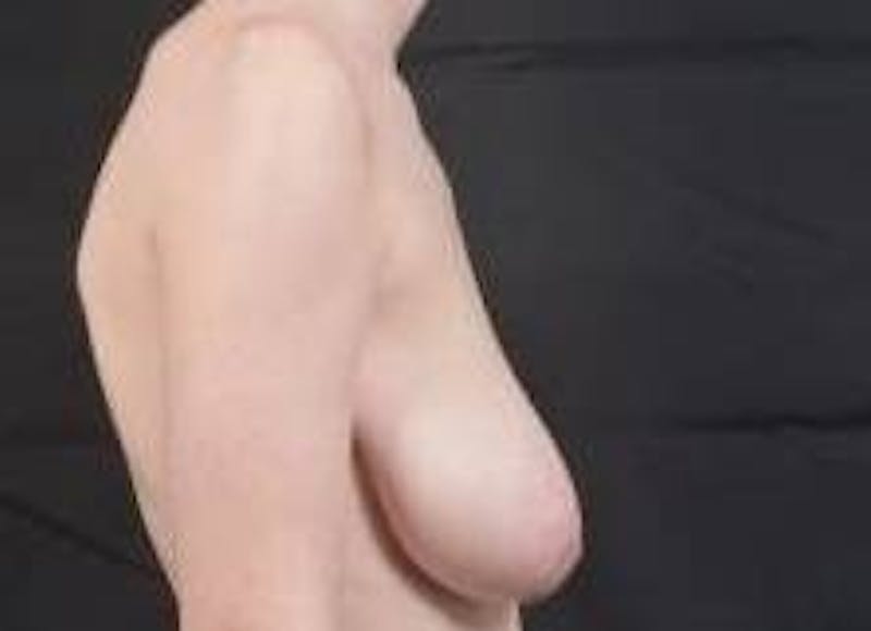 Mastopexy Before & After Gallery - Patient 656836 - Image 5