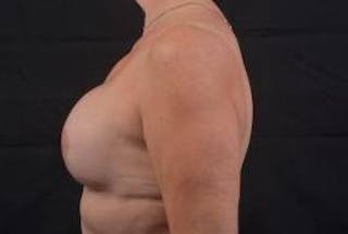 Reconstructive Breast Revision Before & After Gallery - Patient 348145 - Image 4