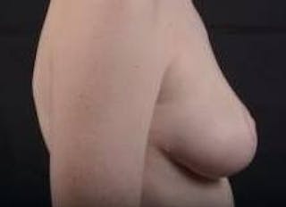 Mastopexy Before & After Gallery - Patient 656836 - Image 6
