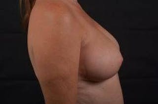 Oncoplastic Reconstruction Before & After Gallery - Patient 118368 - Image 6