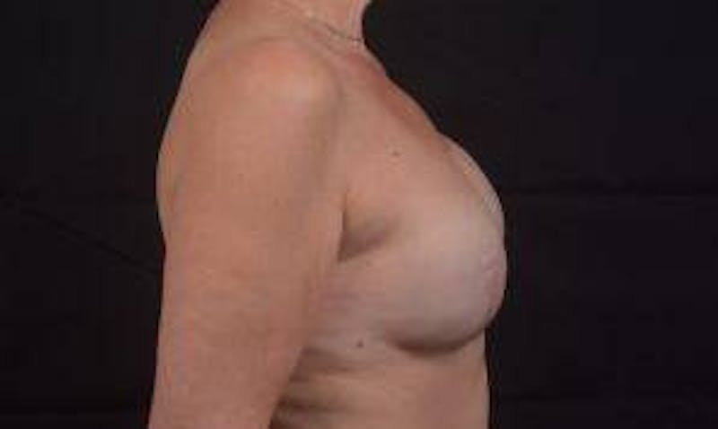 Reconstructive Breast Revision Before & After Gallery - Patient 348145 - Image 5